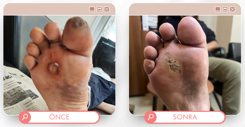 Ayak altı tedavisi önce sonra