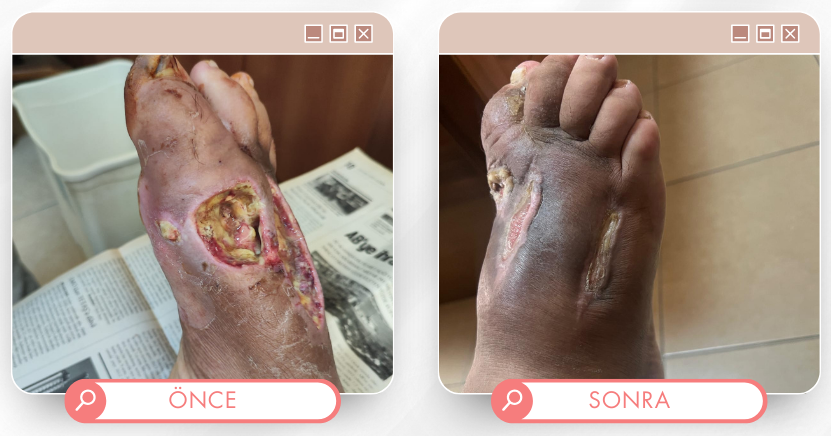 Ayak tedavisi önce sonra