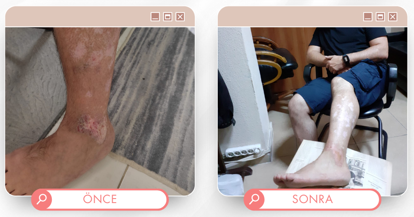 Bacak tedavisi önce sonra