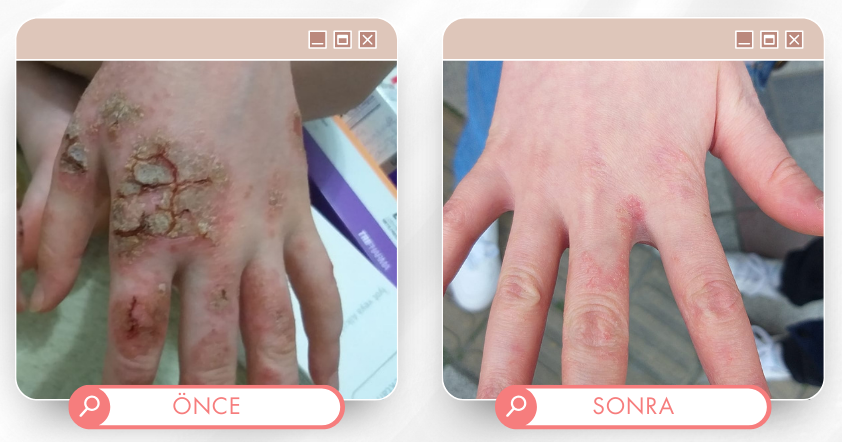 El tedavisi önce sonra