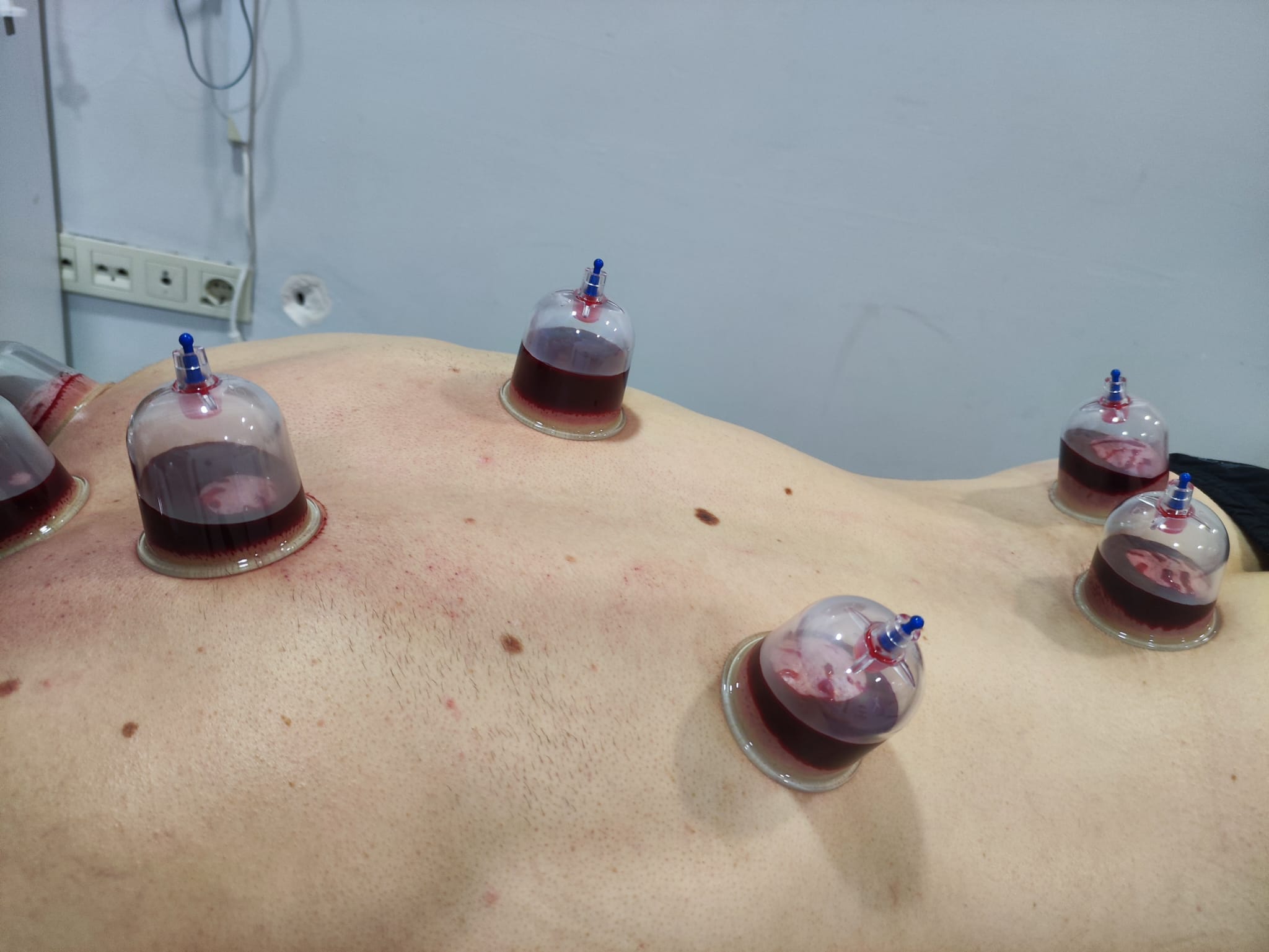 Hacamat tedavisi - Sırt bölgesi tedavisi