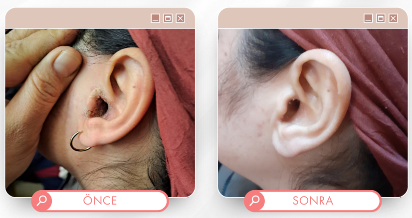 Kulak tedavisi önce sonra