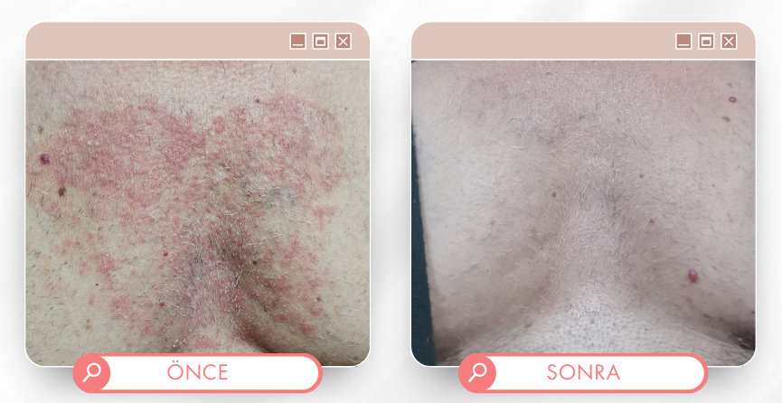 Cilt tedavisi önce sonra