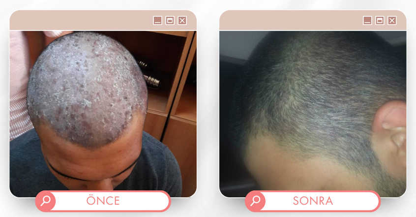 Saç tedavisi önce sonra