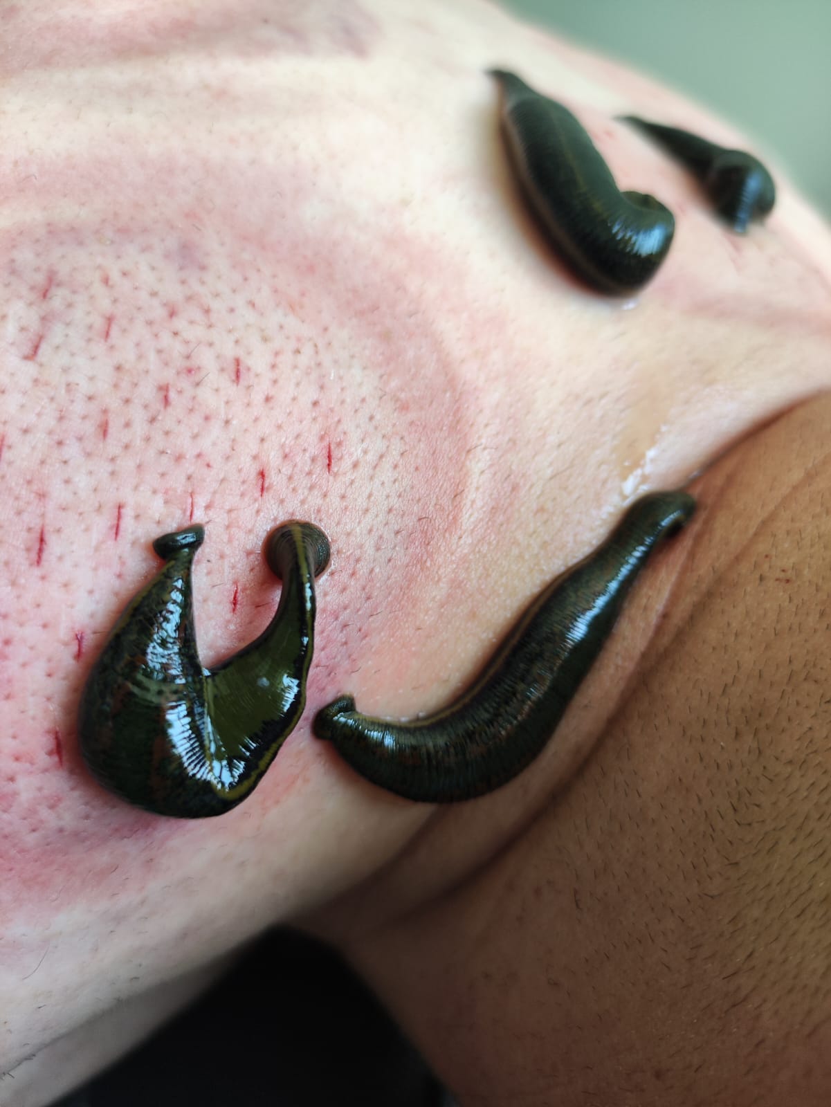 Sülük tedavisi - Leech therapy