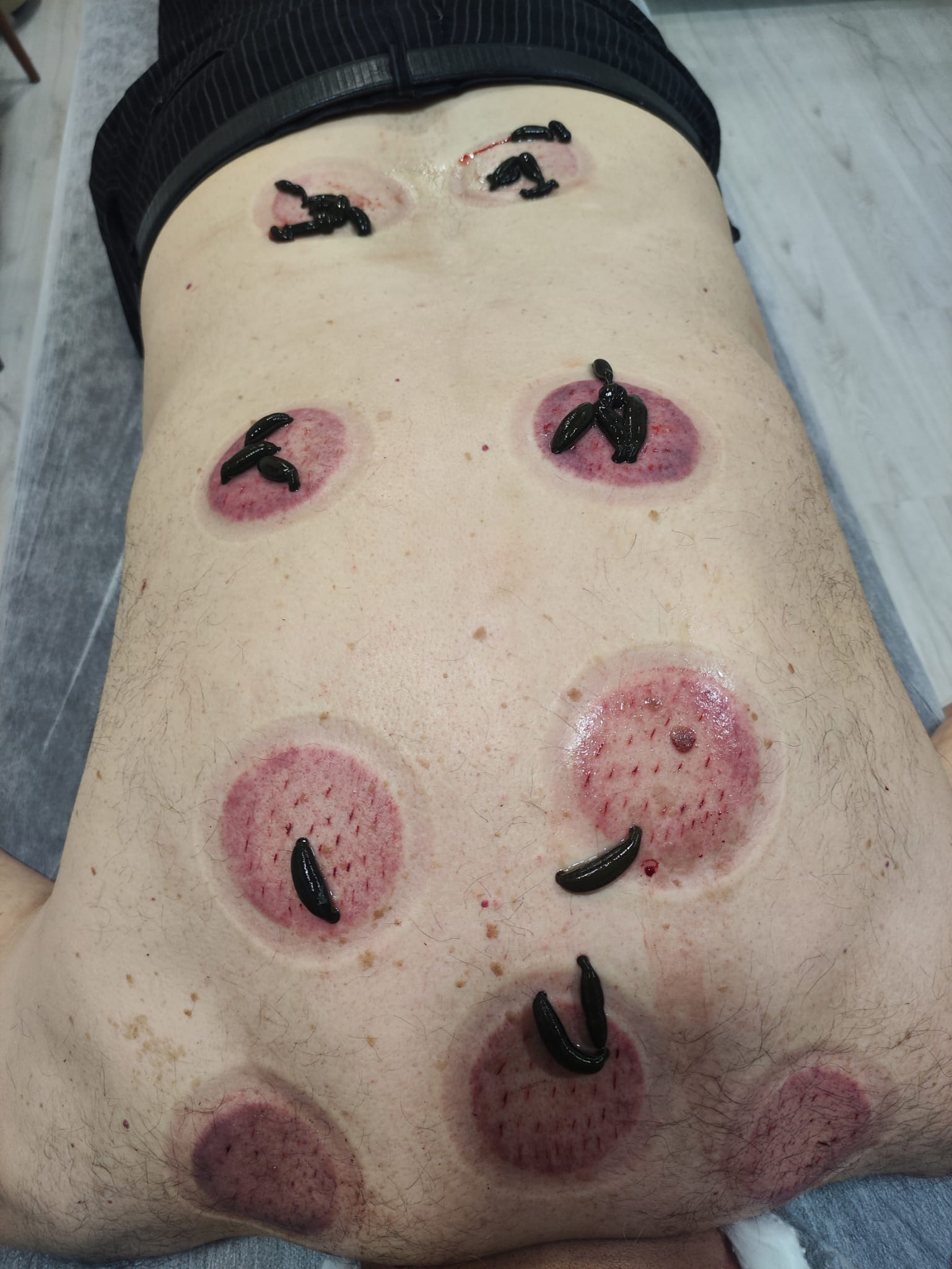 Sülük tedavisi - Karın bölgesi tedavisi