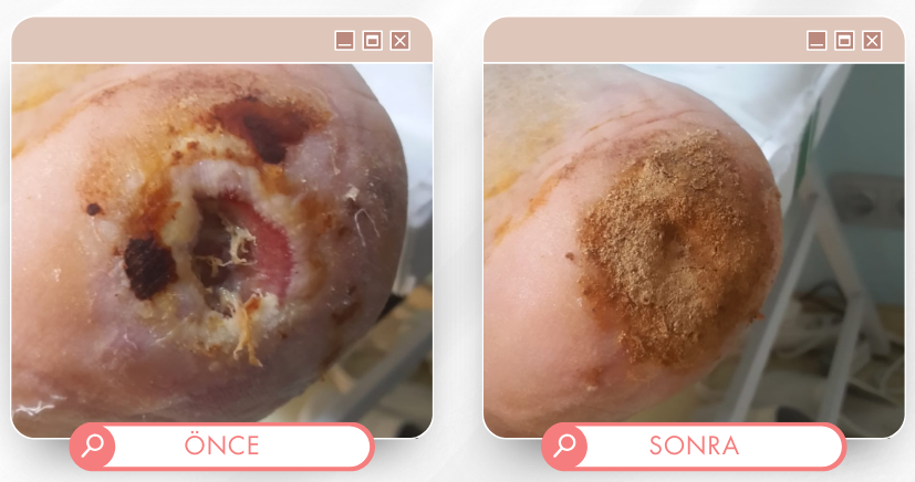 Topuk tedavisi önce sonra